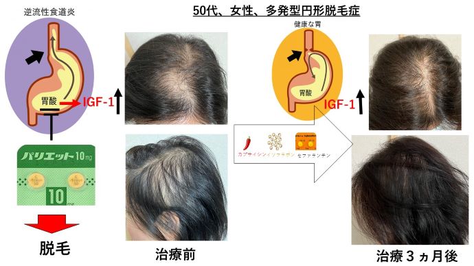 円形脱毛症　病院